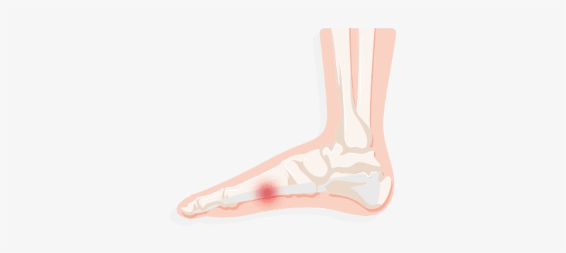 Common Treatments Include New Shoes, Arch Supports, - Sock, transparent png