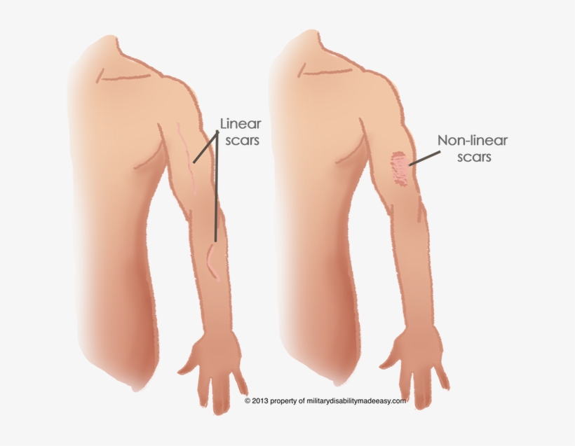 Linear Scar 1 - Linear Scar, transparent png