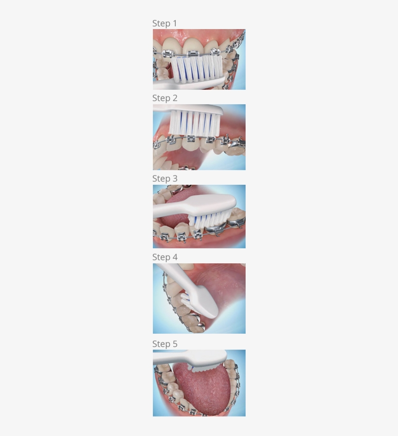 Brushing Steps - Petaluma Orthodontics - Brush Your Teeth When You Have Braces, transparent png
