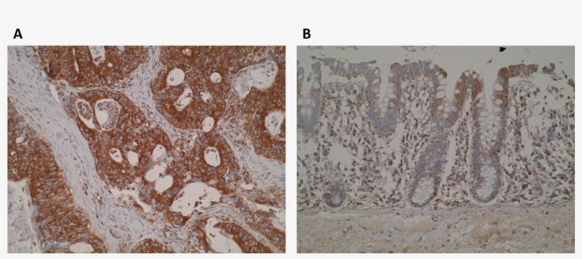 Immunohistochemistry Images Are Showing A Strong Cytoplasmic - Floor, transparent png