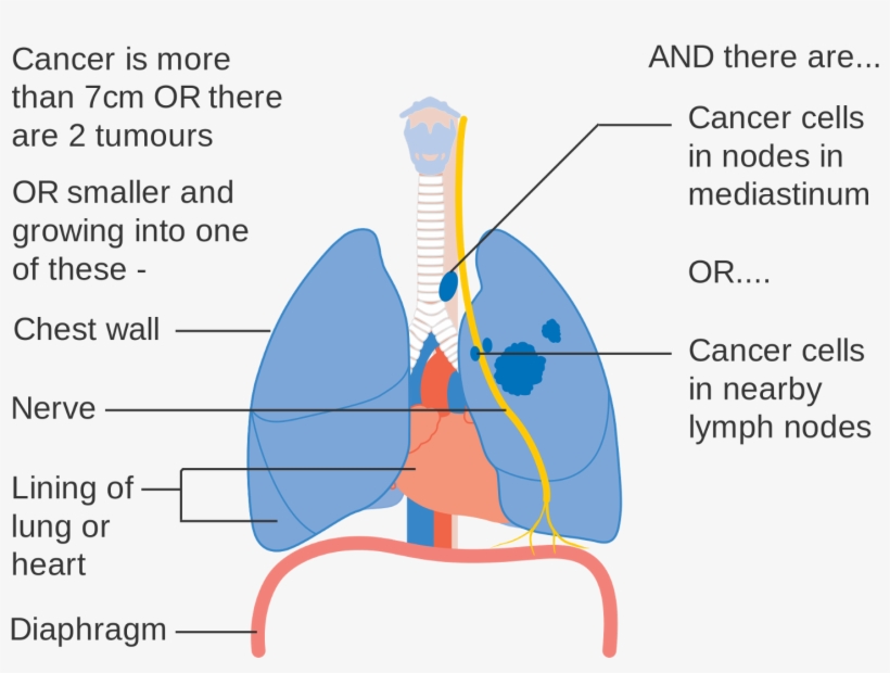 Common Lung Diseases And Their Causes - Side Determination Of Lungs, transparent png