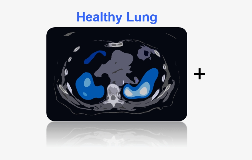 Healthy-lung - Cancer, transparent png
