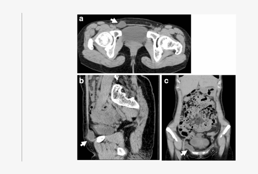 Computed Tomography Scans Showing A Round Cystic Lesion - Computed Tomography, transparent png