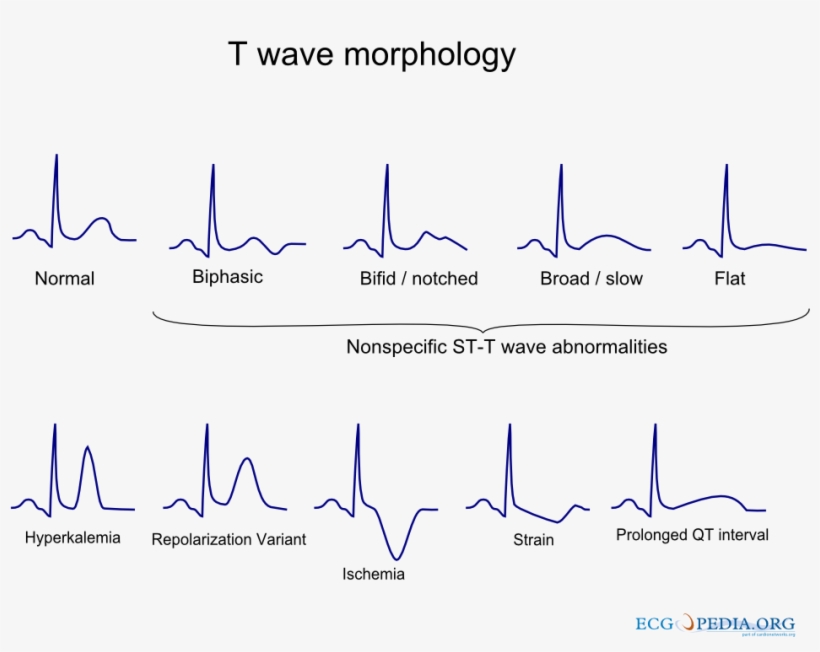 T Wave Morphology, transparent png
