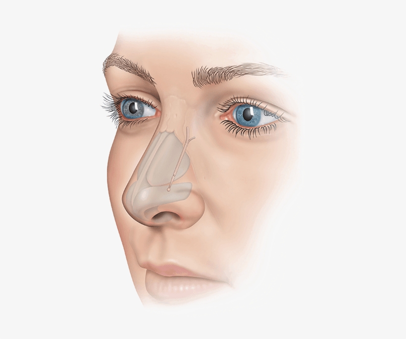 Patients Who Have Experienced Nasal Obstruction From - Nose Implant, transparent png