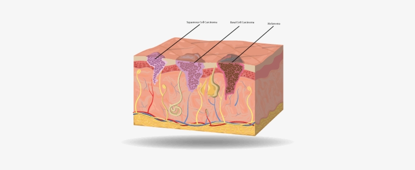 Large Skin Cancer Cell - Box, transparent png