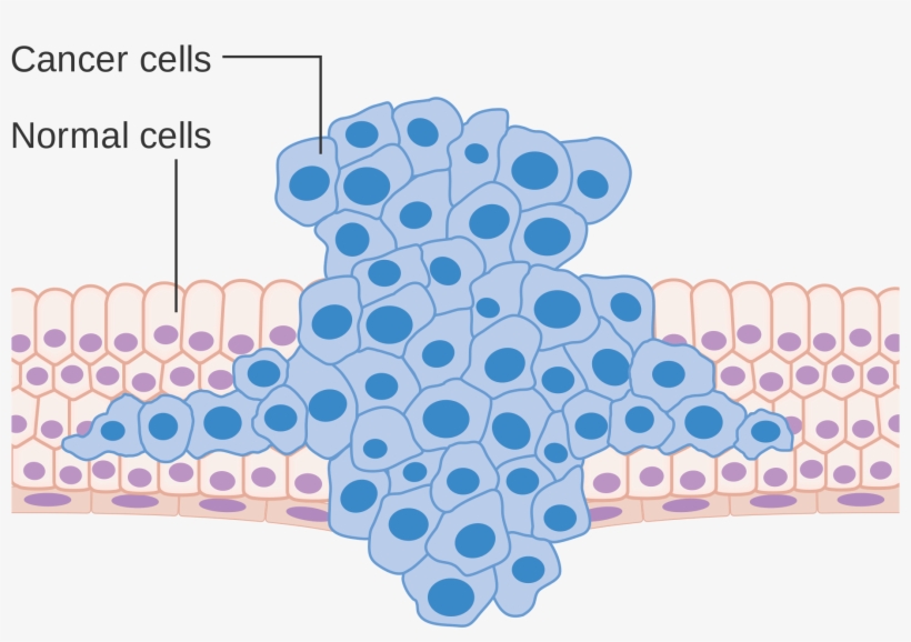Why Haven't We Cured Cancer Yet A Report From The Forefront - Cancer Cells Metastasis, transparent png