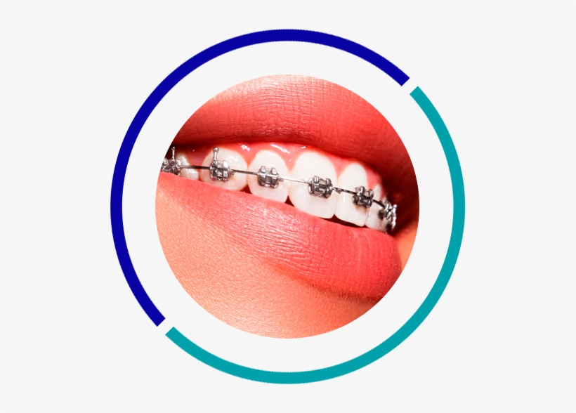 Orthodontics - Dental Braces Price In Qatar, transparent png