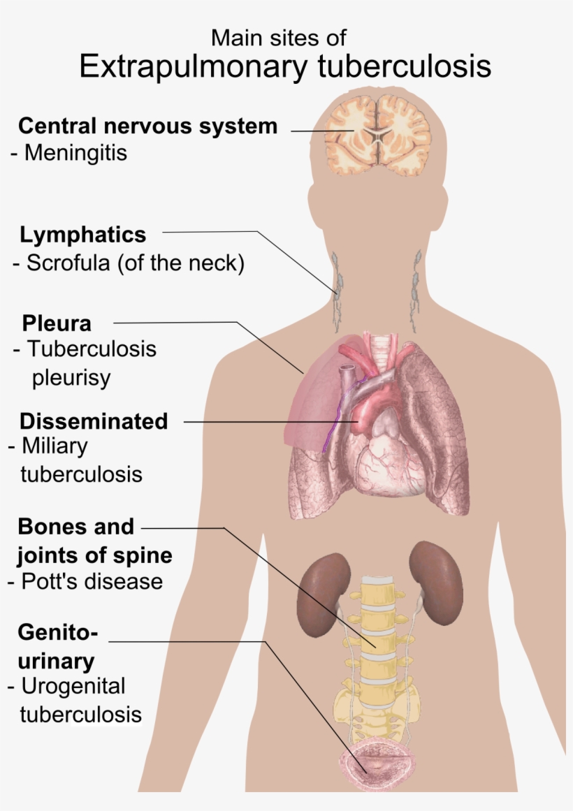 Extrapulmonary Tuberculosis Symptoms - Main Sites Of Extrapulmonary Tuberculosis, transparent png