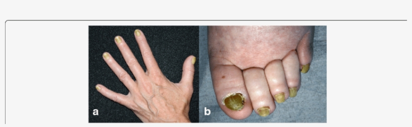 Yellowing Of All 10 Finger And (b) Toe Nails - Yellow Nail Syndrome, transparent png
