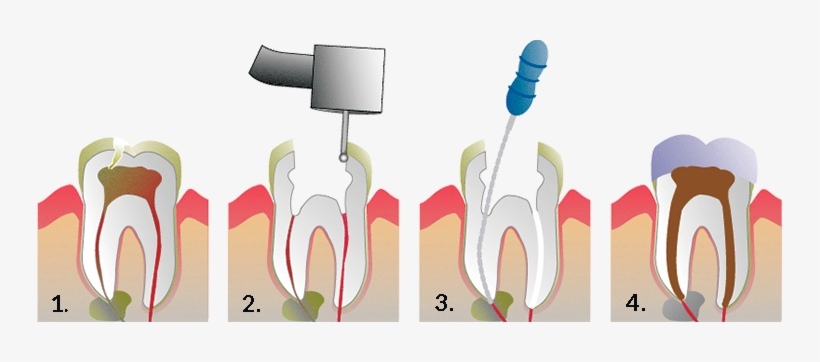 Root Canal Therapy Is Required When A Tooth Is Infected - One Visit Root Canal, transparent png