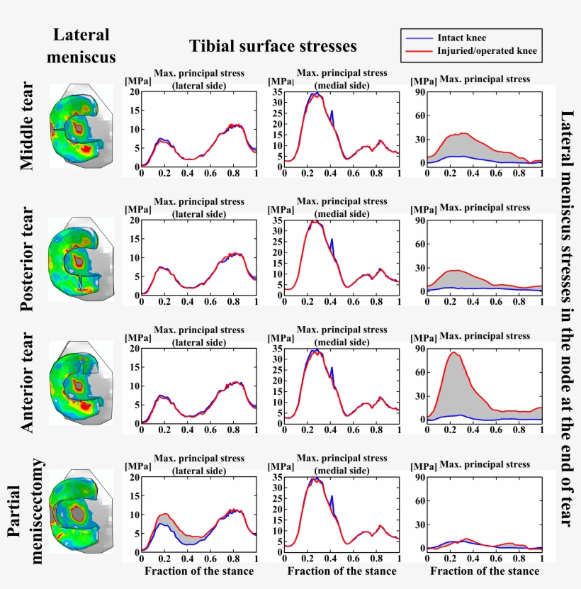 Effects Of Radial Tears And Partial Meniscectomy On - Diagram, transparent png