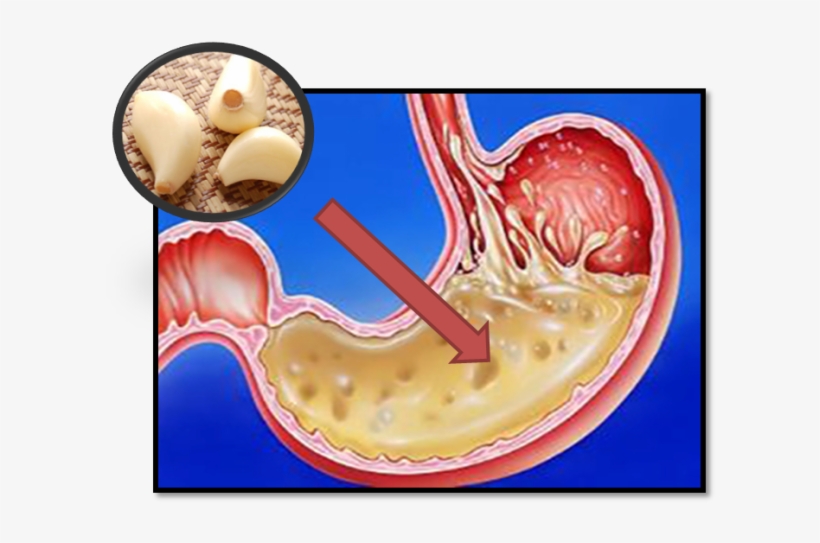 Esto Es Lo Que Pasa Cuándo Te Comes Un Ajo Con El Estómago - Neutralize Stomach Acid, transparent png