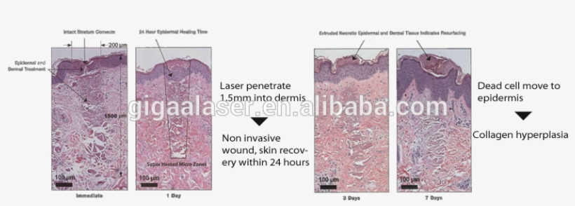 The Beautyscan™ Transmits The 1550nm Laser Energy In - Lace, transparent png
