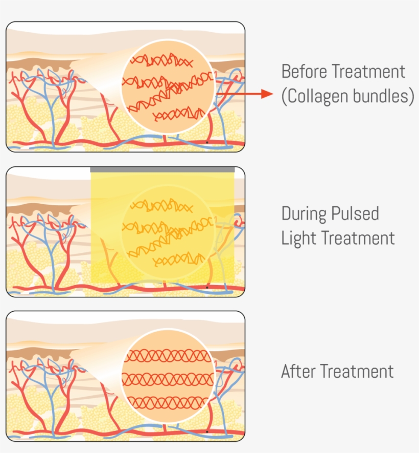 Laser Skin Tightening Exeter Medical Before, During - Calligraphy, transparent png