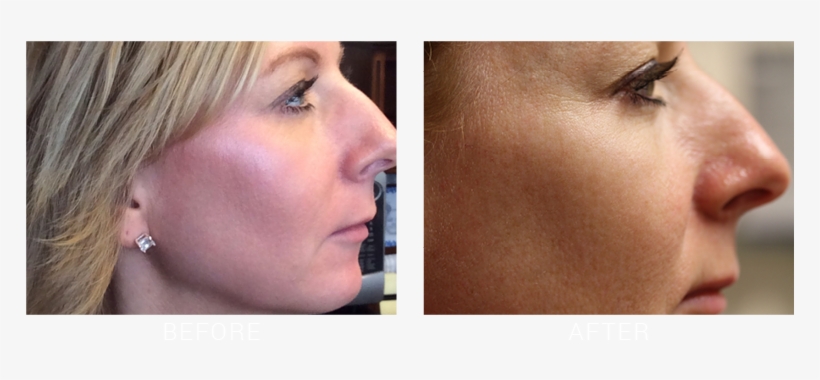 Suttonderm Beforeaftergallery Fraxel2 - Scar, transparent png