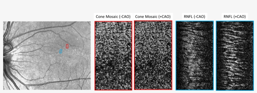 This Image Consists Of Three Black And White Pictures - Optical Fibers Retina Adaptive Optics, transparent png