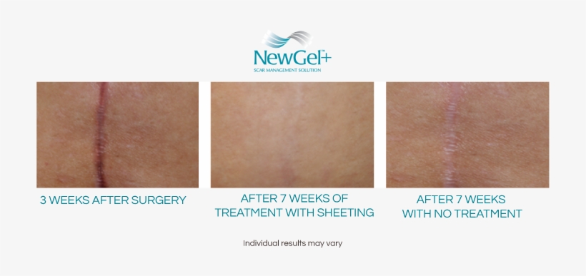 While Scars Vary Greatly In Every Aspect, Depending - Newgel+ Silicone Gel For Scar Management - 8" Abdomen/c-section, transparent png