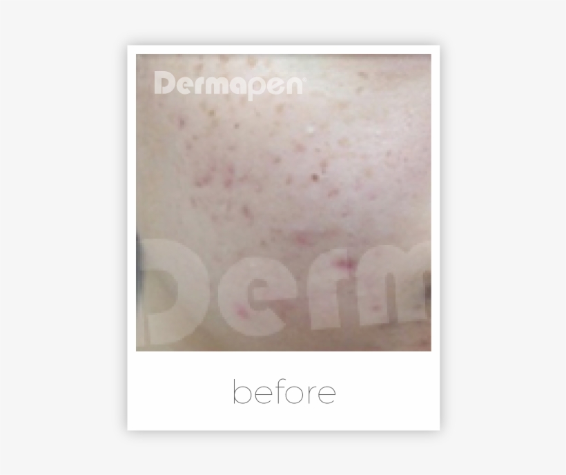 Dermapen For Acne Scars - Text, transparent png