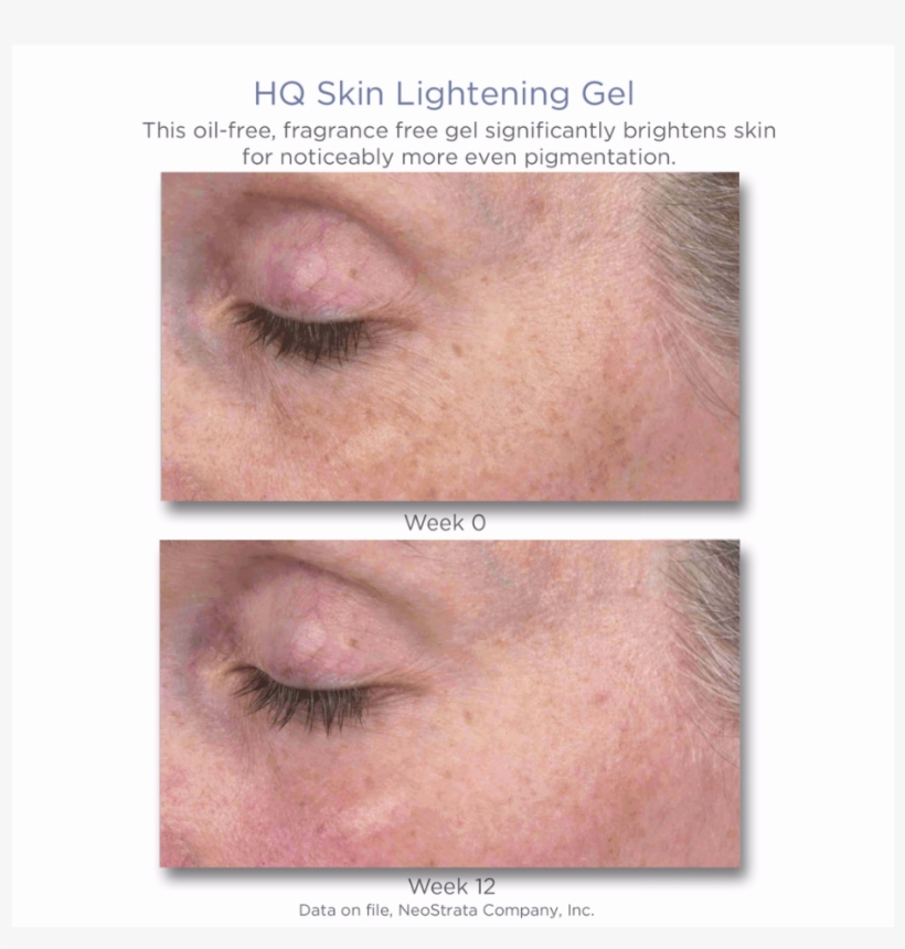 Download - Neostrata Spot Lightening Results, transparent png