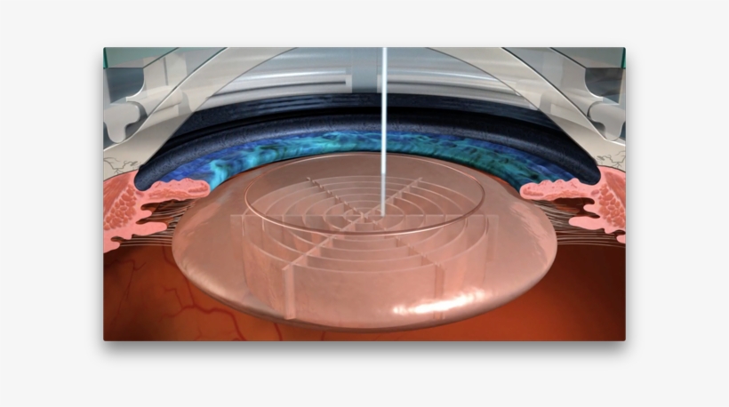 Laser Cataract Surgery - Surgery Cataract, transparent png