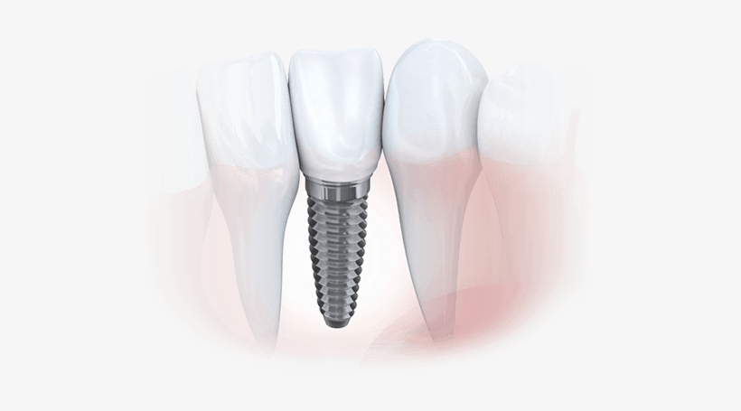 Animation Of Implant Supported Dental Crown - Dental Implant, transparent png
