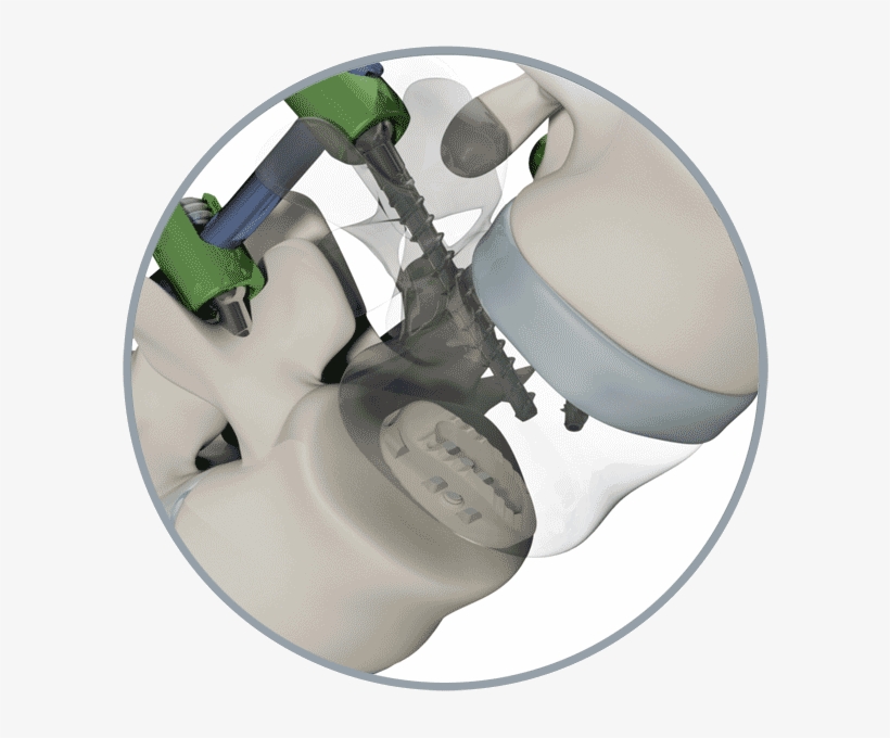 Spinal Spacer System - Novel, transparent png
