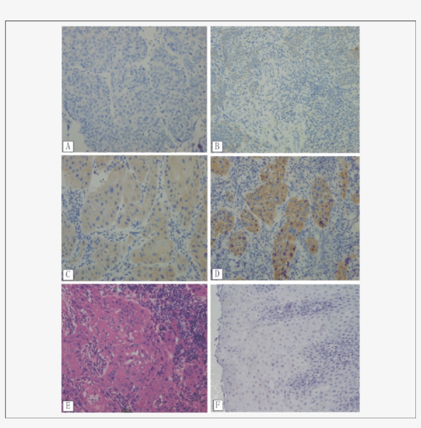 Immunohistochemistry Analysis Of Mtor Expression In - Tile, transparent png