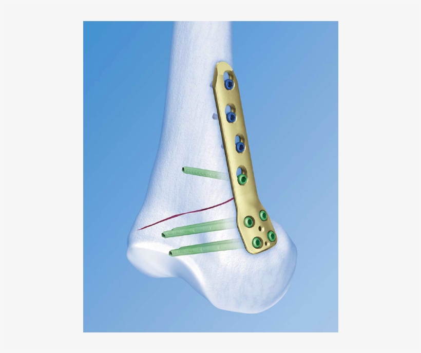Tomofix Medial Distal Femur Plate, transparent png
