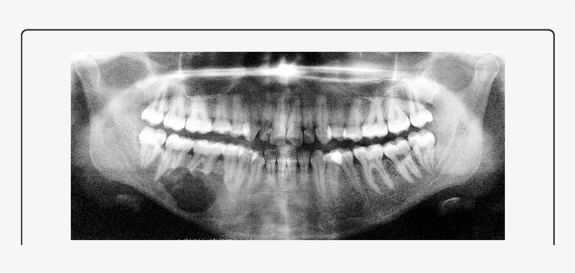Orthopantomogram Unilocular Radiolucency With Scalloped - Radiography, transparent png