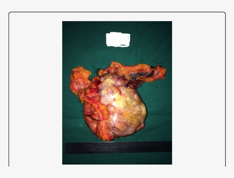 Gross Picture Of The Tumour - Low Grade Endometrial Stromal Sarcoma, transparent png
