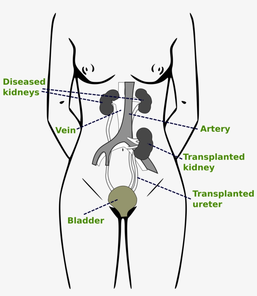 Kidney Transplantation Pdf, transparent png