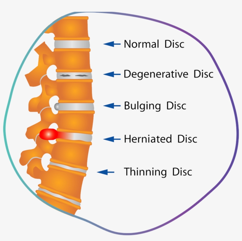 Degenerative Disc Disease - Disc Spine, transparent png