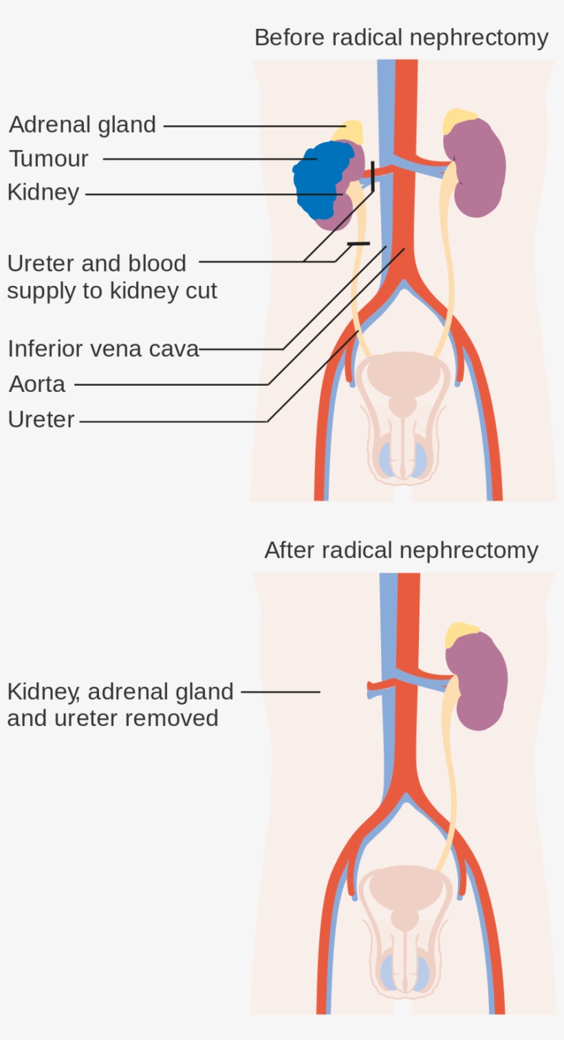 Open - Urology, transparent png