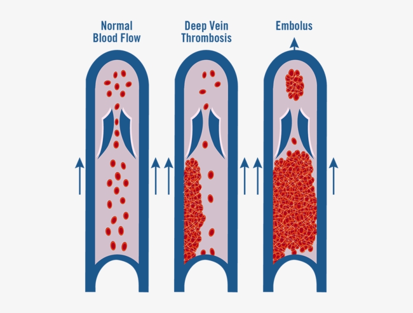 Vein Healthcare Center - World Thrombosis Day 2017, transparent png