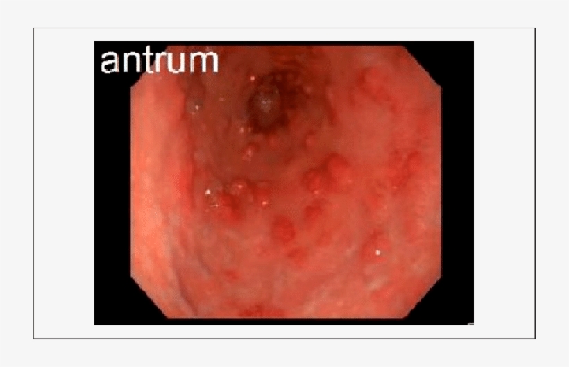 Endoscopy Showing Erythematous Gastric Nodules In The - Erythematous Patches In Stomach, transparent png
