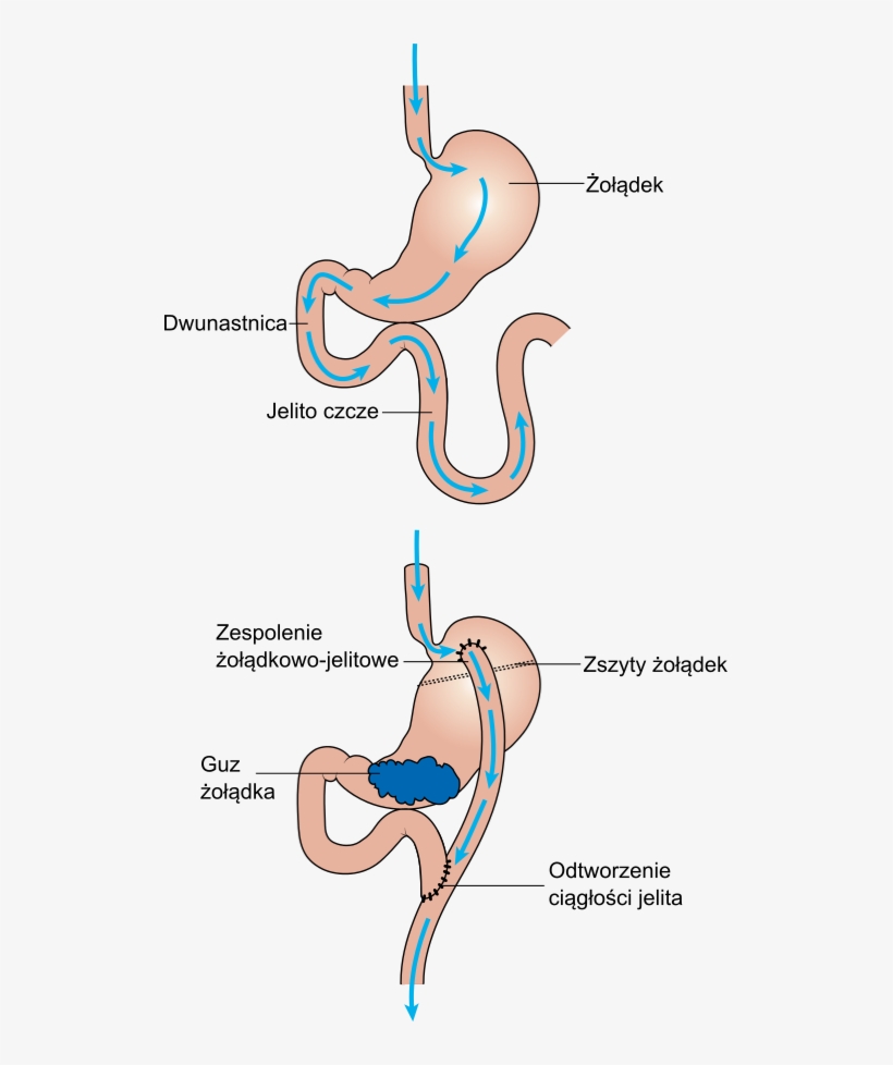 Diagram Showing Before And After Stomach Bypass Surgery - Antrum Żołądka Gdzie, transparent png