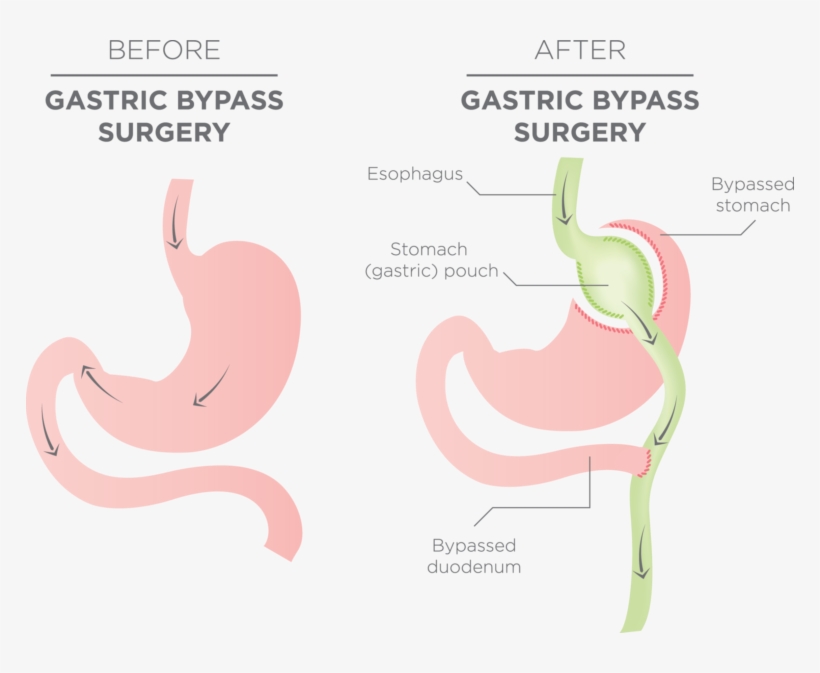 The Upper Is Bypassed Directly To The Small Intestine - Gastric Bypass, transparent png