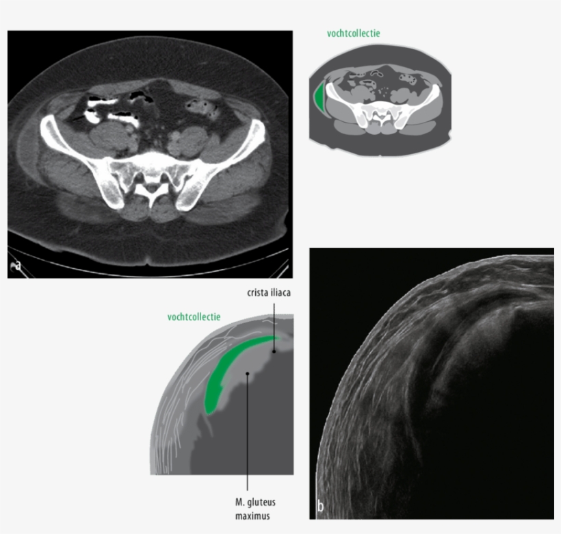 Figuur 1 Een Transversale Ct-coupe Van Het Abdomen - Computed Tomography, transparent png
