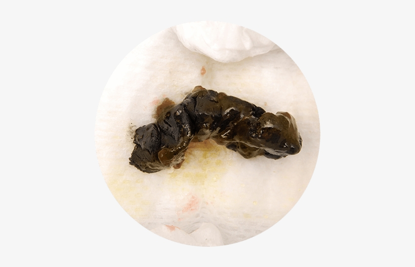 Download Transparent Discover What Causes Black Baby Poop With The