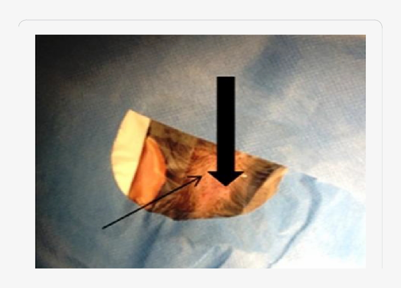 Thin Arrow Indicates The Former Scar After A Non Skin - Surgery, transparent png