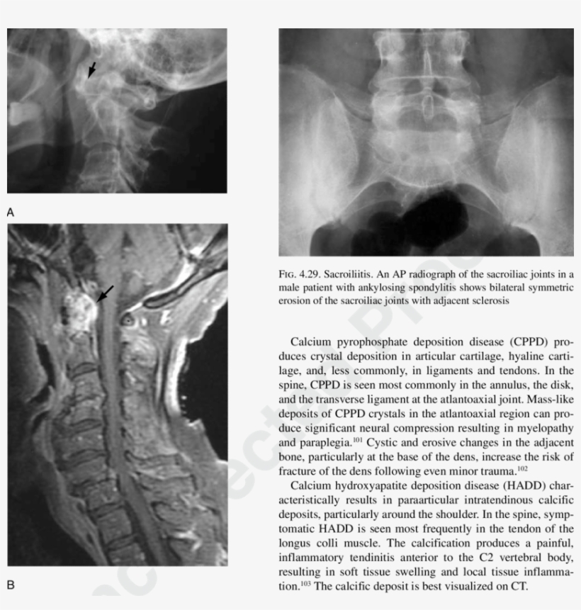 A Lateral Radiograph Shows Widening Of The Atlantoaxial - Atlantoaxial Joint Rheumatoid Arthritis, transparent png