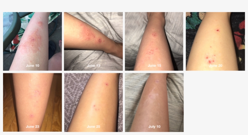 This Is My Leg Now From The Poison Ivy - Health Care, transparent png