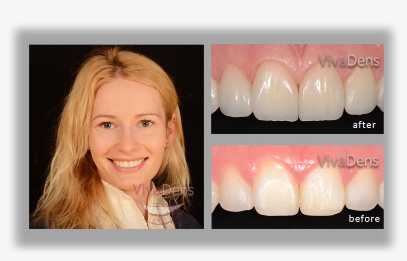 Why To Choose Direct Aesthetic Restoration Procedure - Tooth Bleaching, transparent png