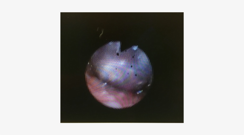 The Fiberoptic Was Placed In The Right Naris And Advanced - Light, transparent png