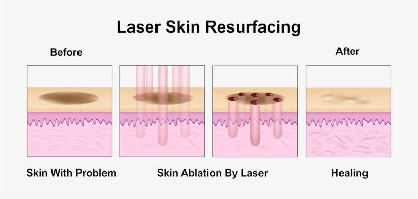 Acne Sometimes Feels Like A Double Punishment- First - Icon 1540 Fractional Laser, transparent png