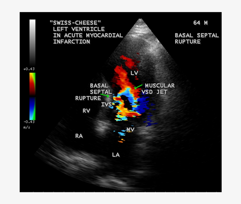 Apical Four Chamber View Showing The Basal Septal Rupture - Muscular Vsd Swiss Cheese, transparent png