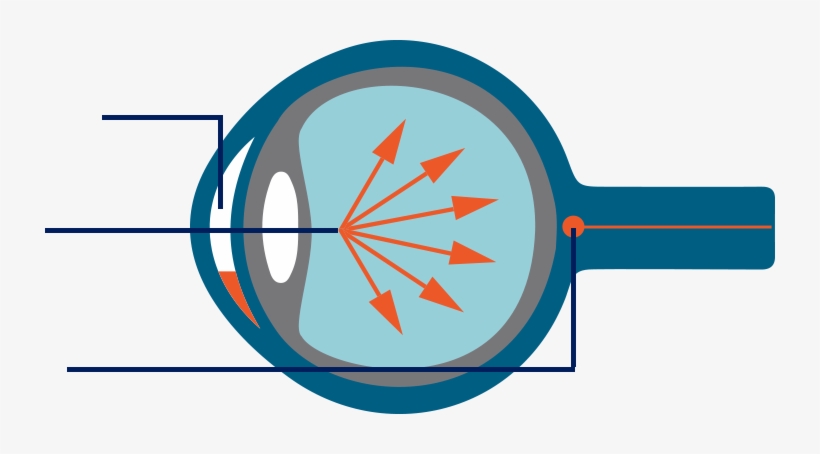 Glaucoma, transparent png