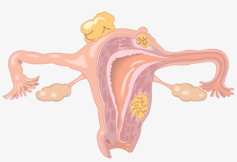 Signs Of Endometriosis - Fertility Disorder, transparent png