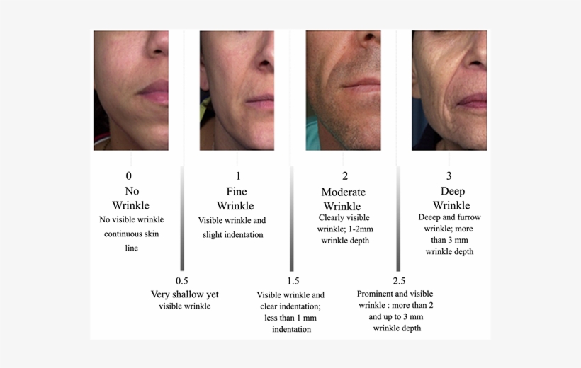 Reference Photographs Of The Four Main Classes For - Fitzpatrick Wrinkle Scale, transparent png
